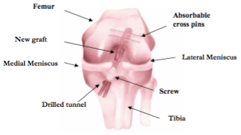 ACL Reconstruction Surgery